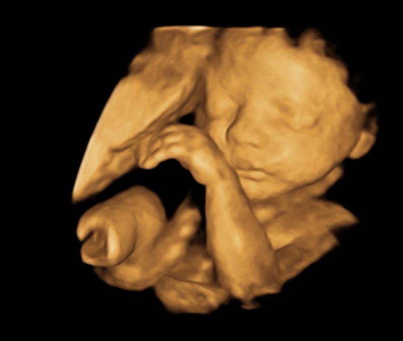 baby 3D ultrasound imaging