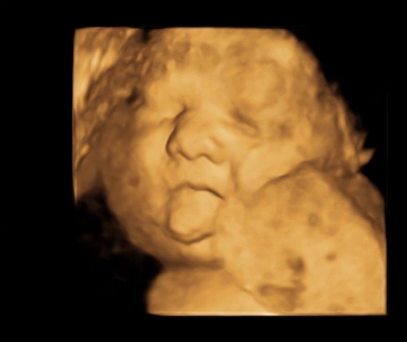 baby 3D ultrasound imaging