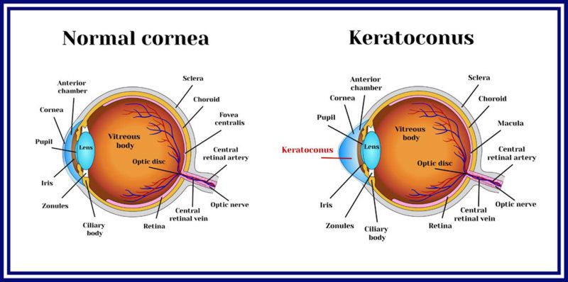 Keratoconus