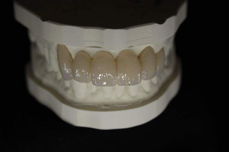 Techsource Porcelain Crowns