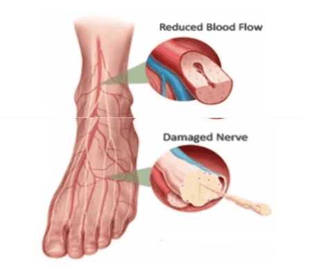 Peripheral neuropathy