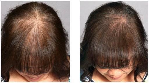 Scalp Micropigmentation