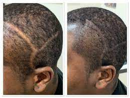 Scalp Micropigmentation