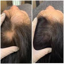 Scalp Micropigmentation
