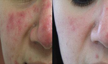 Laser for Rosacea