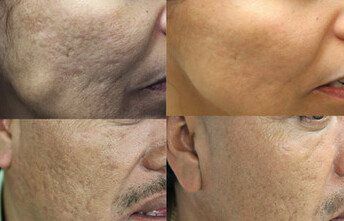 Acne Scars