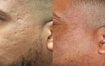 Laser skin