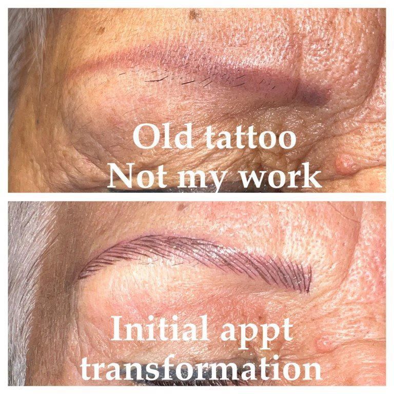 SKIN TIGHTENING