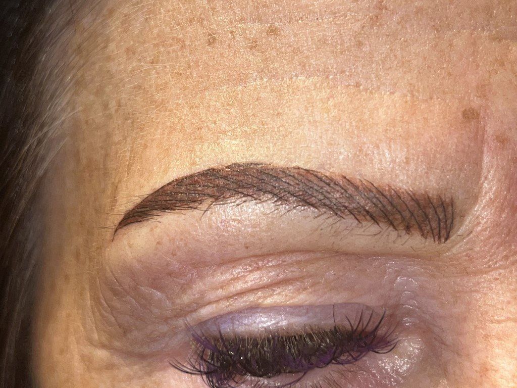 PLASMA FIBROBLAST SKIN TIGHTENING