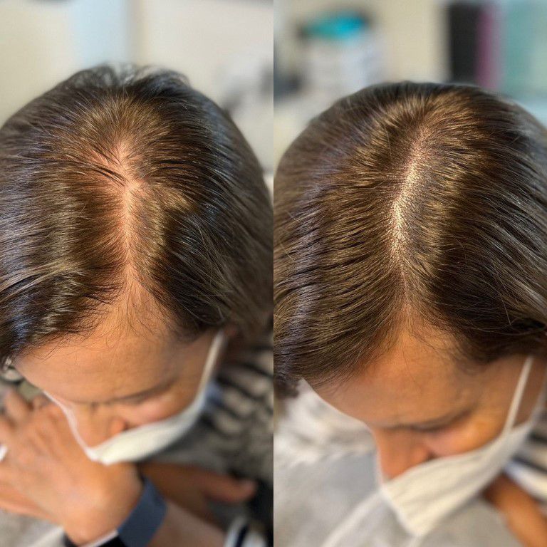 Scalp Micropigmentation