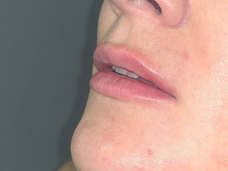 Micropigmentation