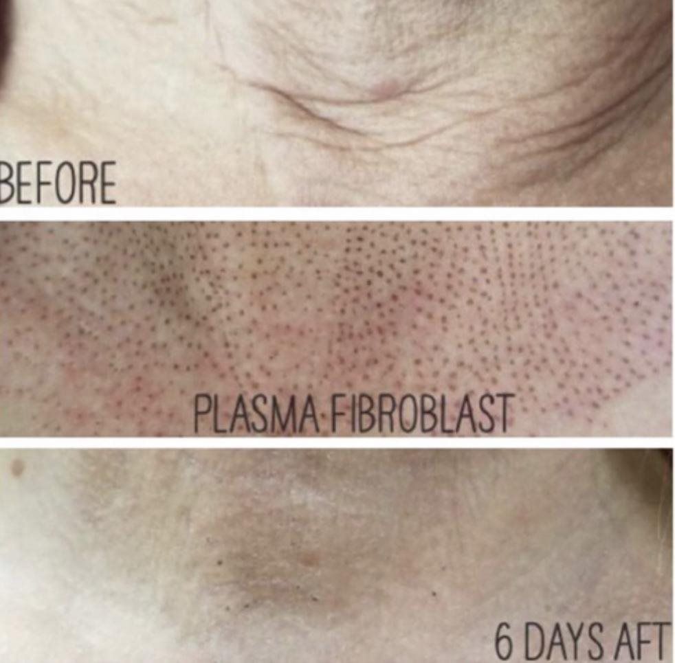 FibroBlast Plasma REBEL, LLC