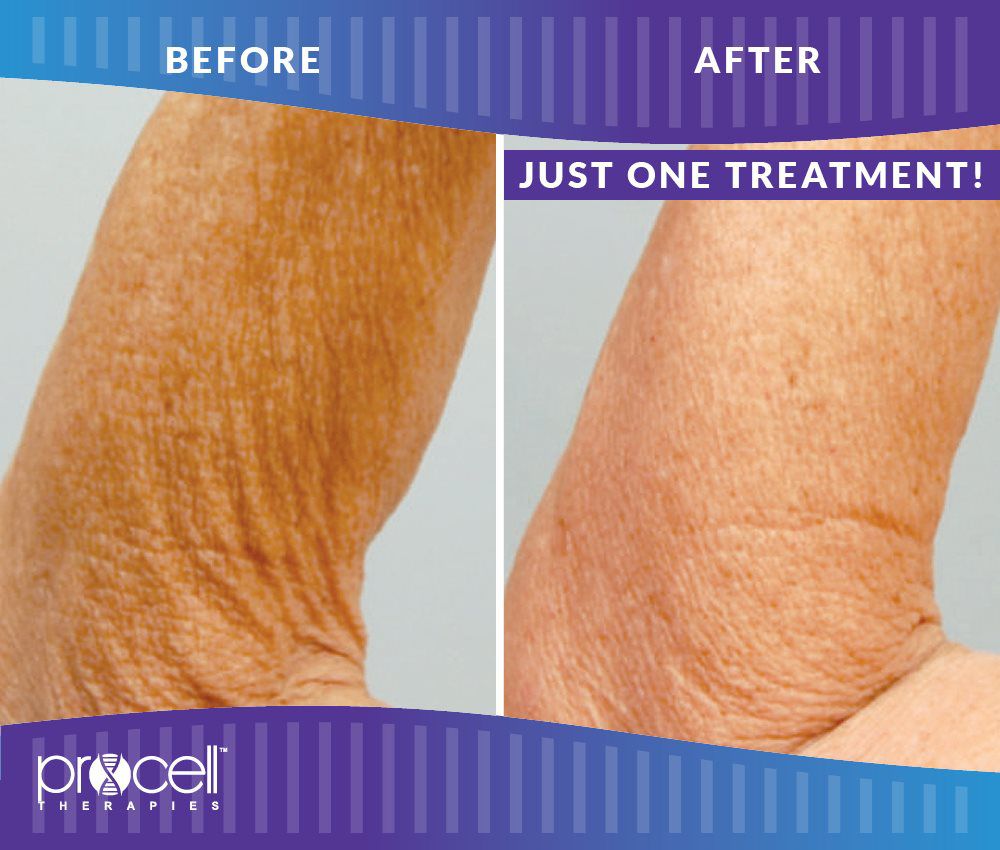 ProCell Microchanneling (Micro-needling) - CryoCareUSA