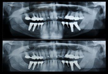 dental xray