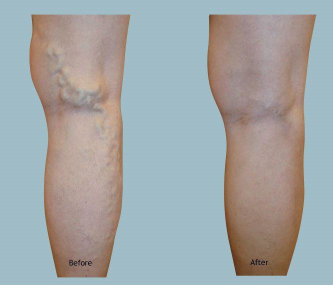 Gallery I Varicose Vein Expert San Jose, Los Gatos, Campbell, and