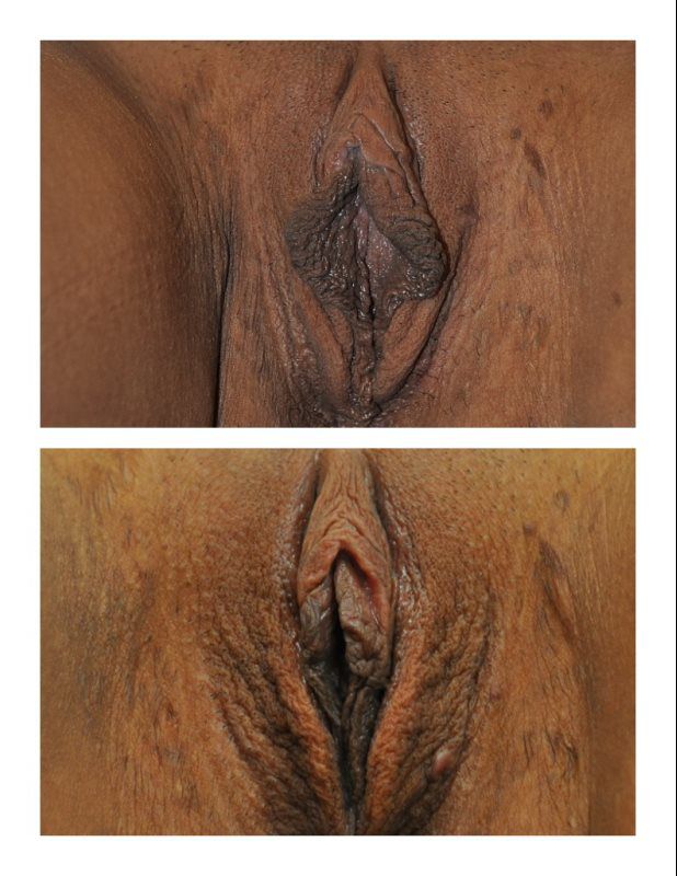 labiaplasty2shw