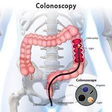 Colorectal cancer (CRC)