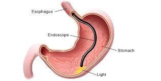 upper endoscopy