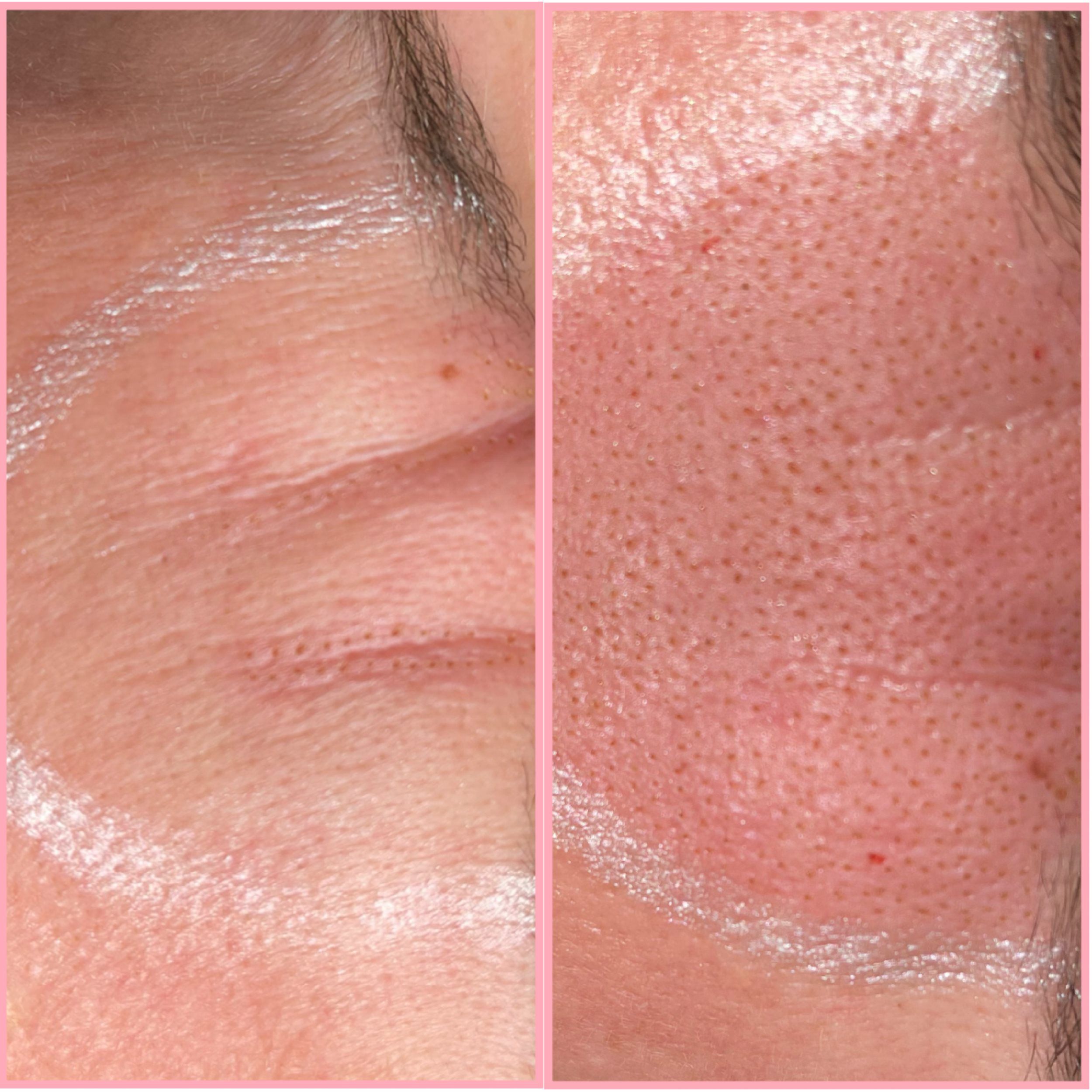 fibroblast-plasma-rebel-llc