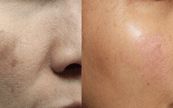 Melasma