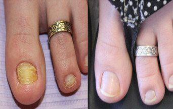 Laser for nail fungus