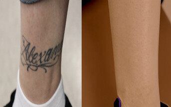 Tattoo Removal