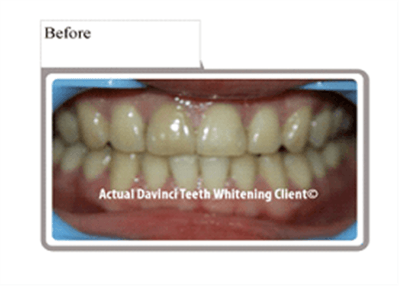 DaVinci Professional Teeth Whitening Longmont J Marie Skin Studio J