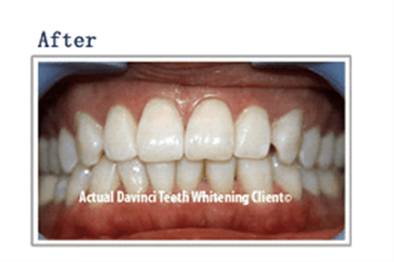 DaVinci Professional Teeth Whitening Longmont J Marie Skin Studio J