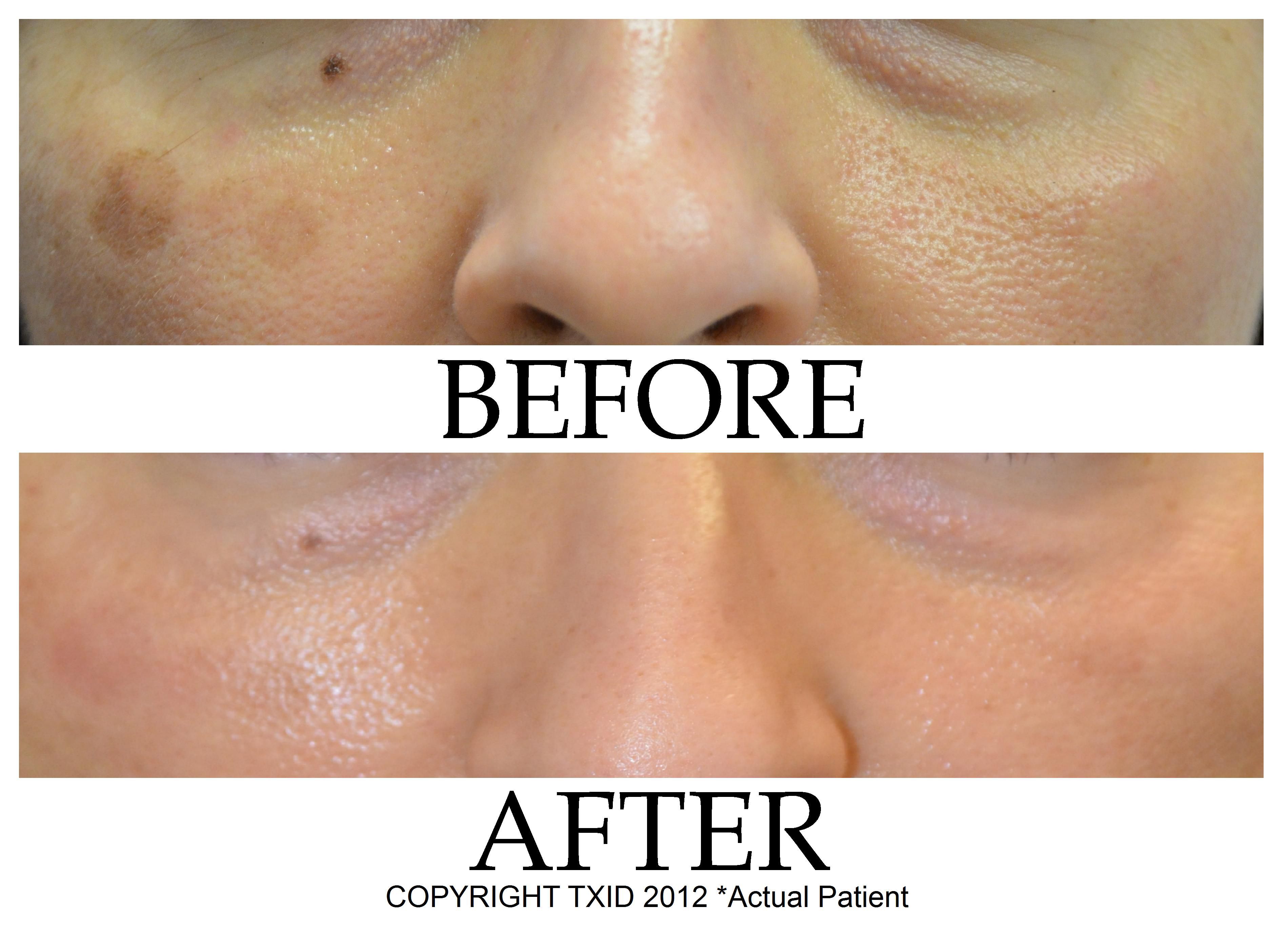 Pigmented Spots San Antonio Dermatology Pigmented Spots San Antonio Dermatology