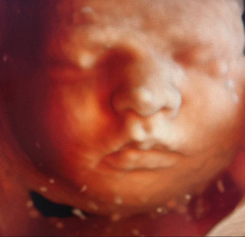 Ultrasound