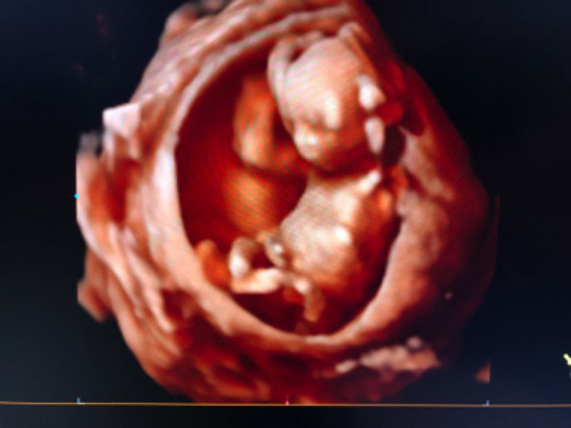 5d Gender Surprise Reveal