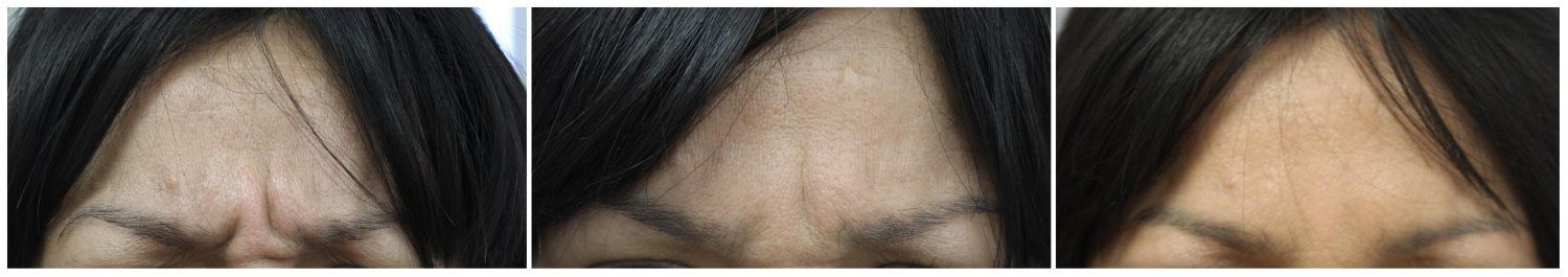 Wrinkle Reduction - San Antonio Dermatology