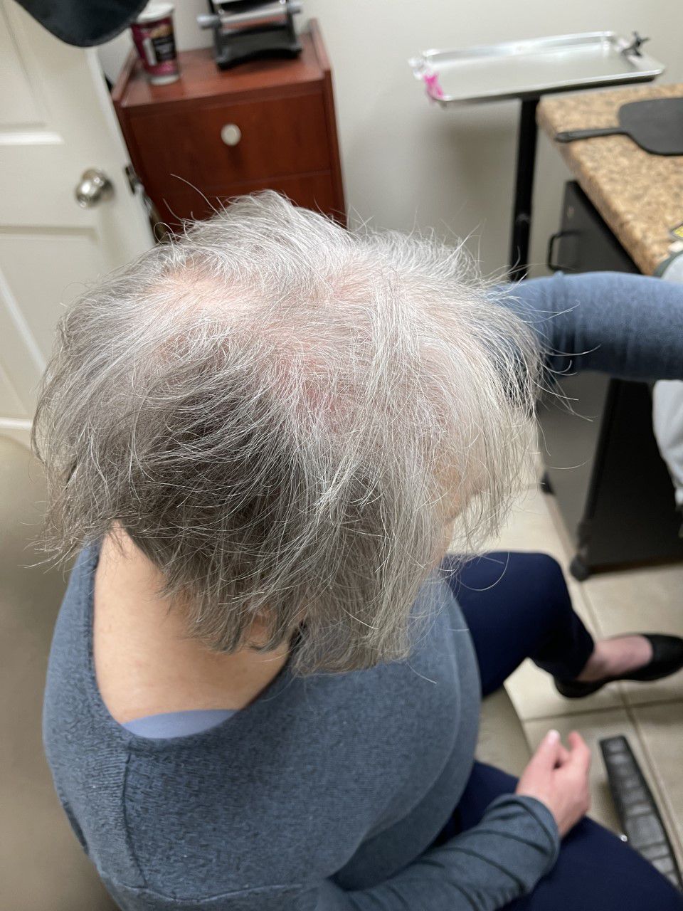 Before Hair System 2