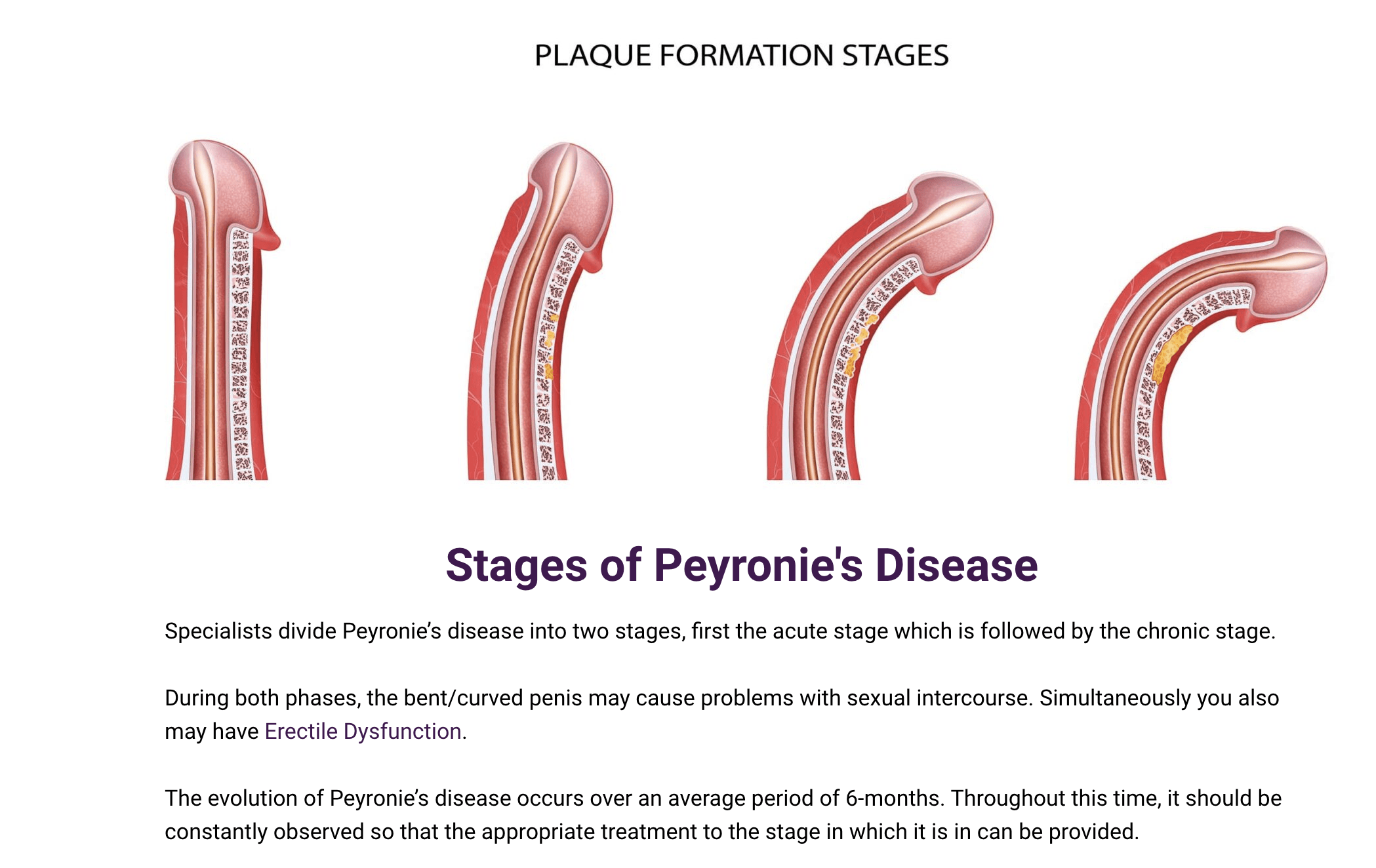 Peyronie's Disease Treatment Anchor Wellness Clinic Clearwater, FL